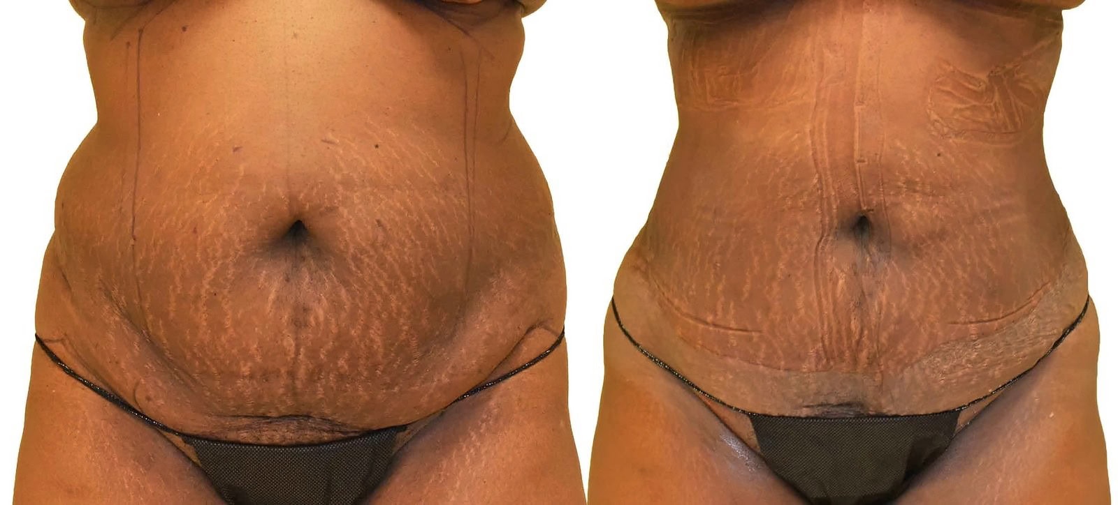 Lipo 360 before and after, actual patient of Dr. Long