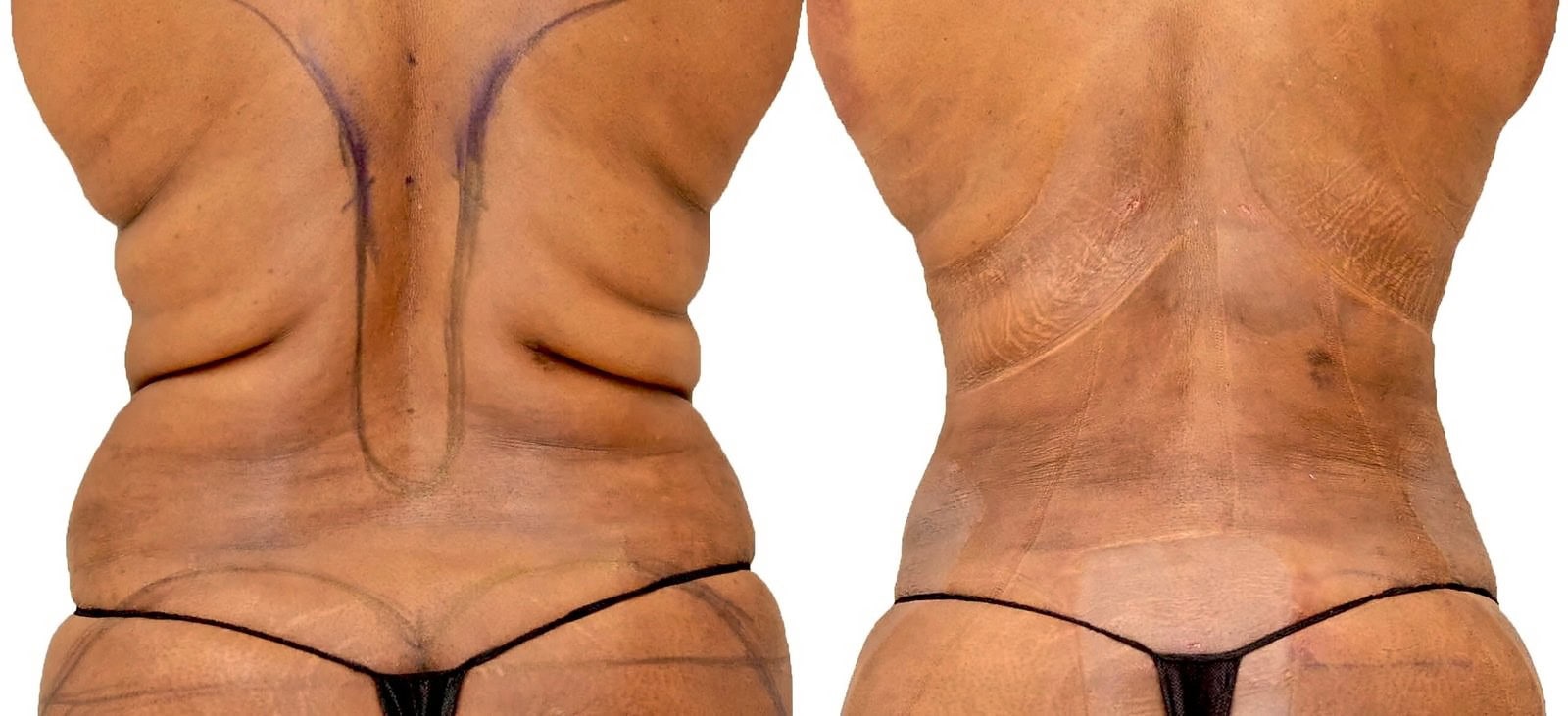 Lipo 360 before and after, actual patient of Dr. Long