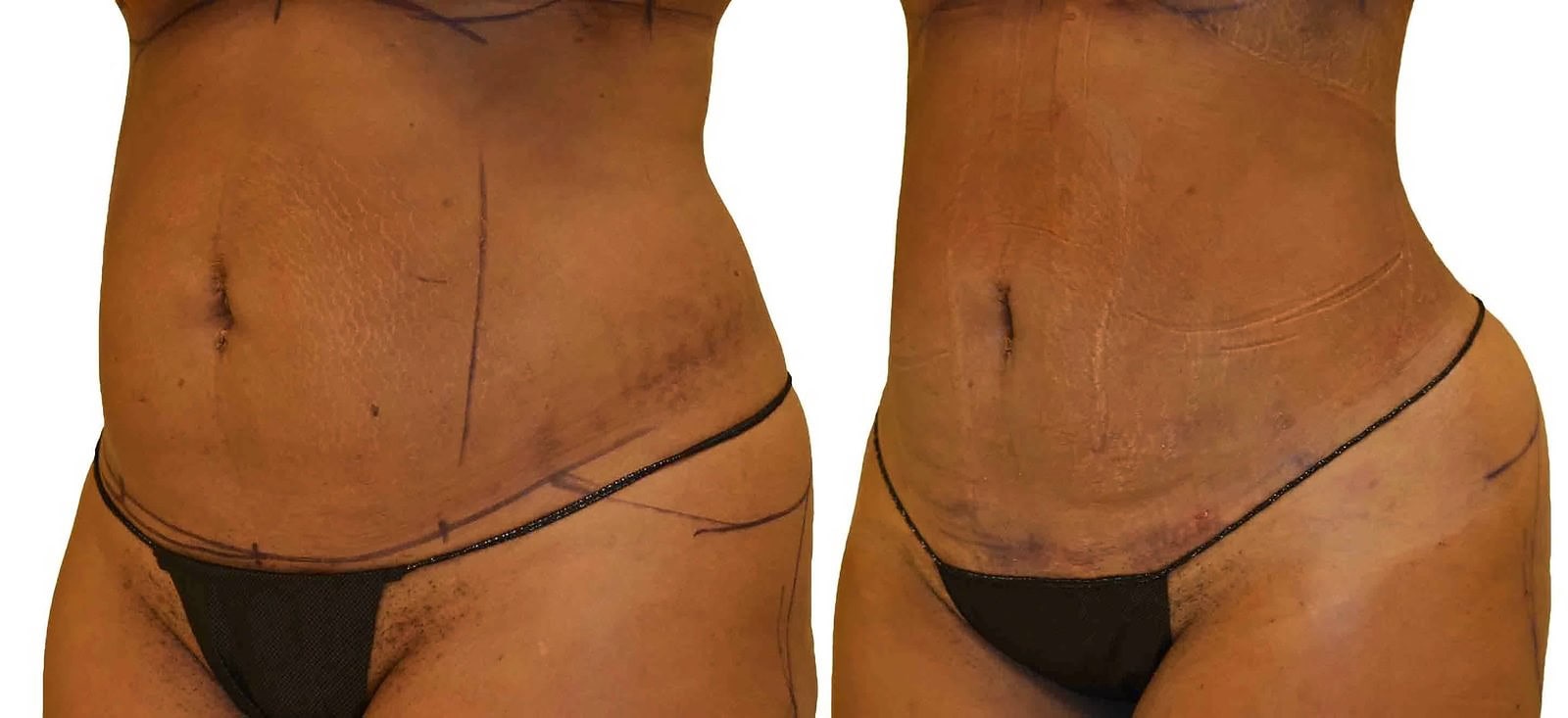 Lipo 360 before and after, actual patient of Dr. Long