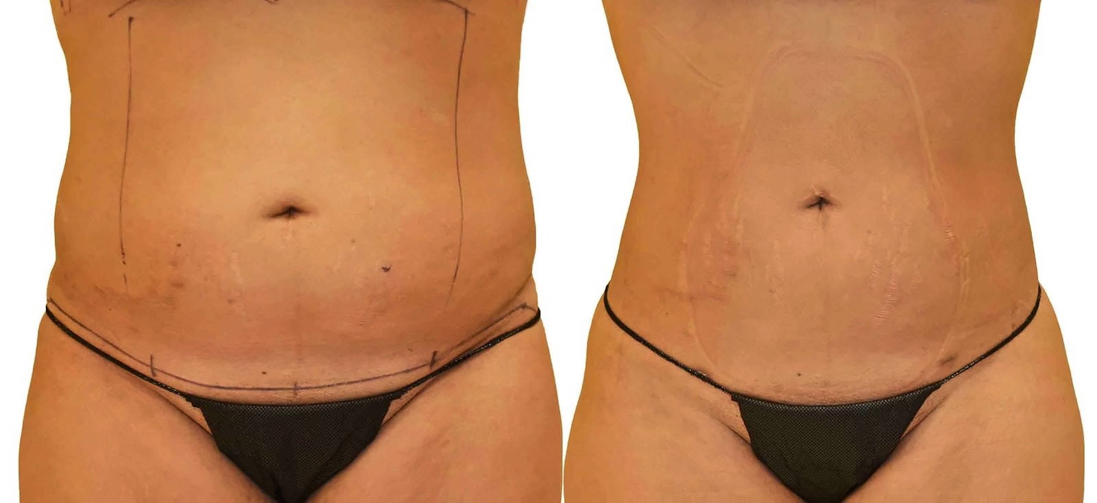 Lipo 360 before and after, actual patient of Dr. Long