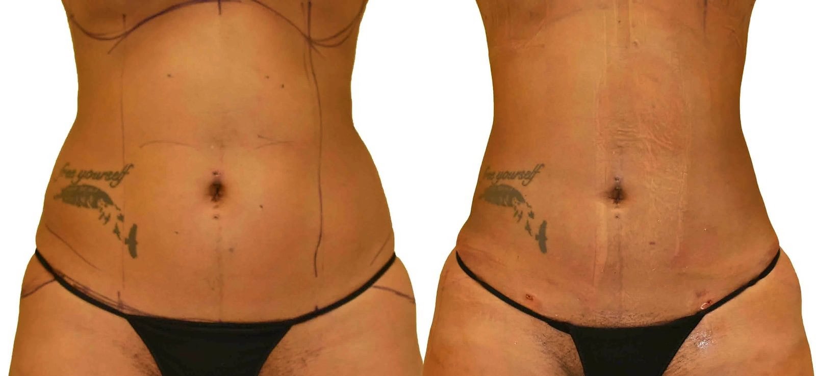 Lipo 360 before and after, actual patient of Dr. Long