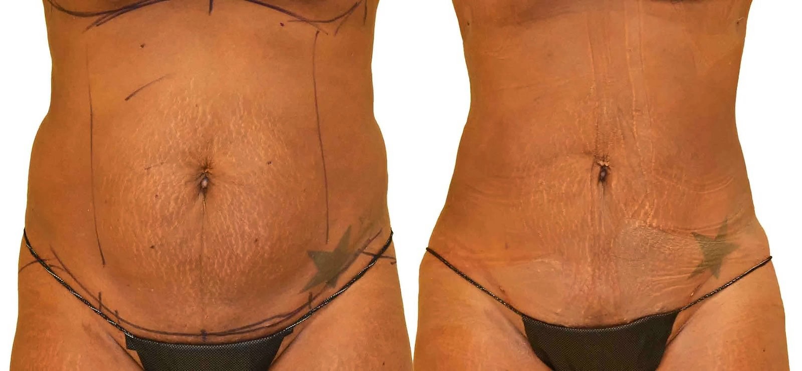 Lipo 360 before and after, actual patient of Dr. Long