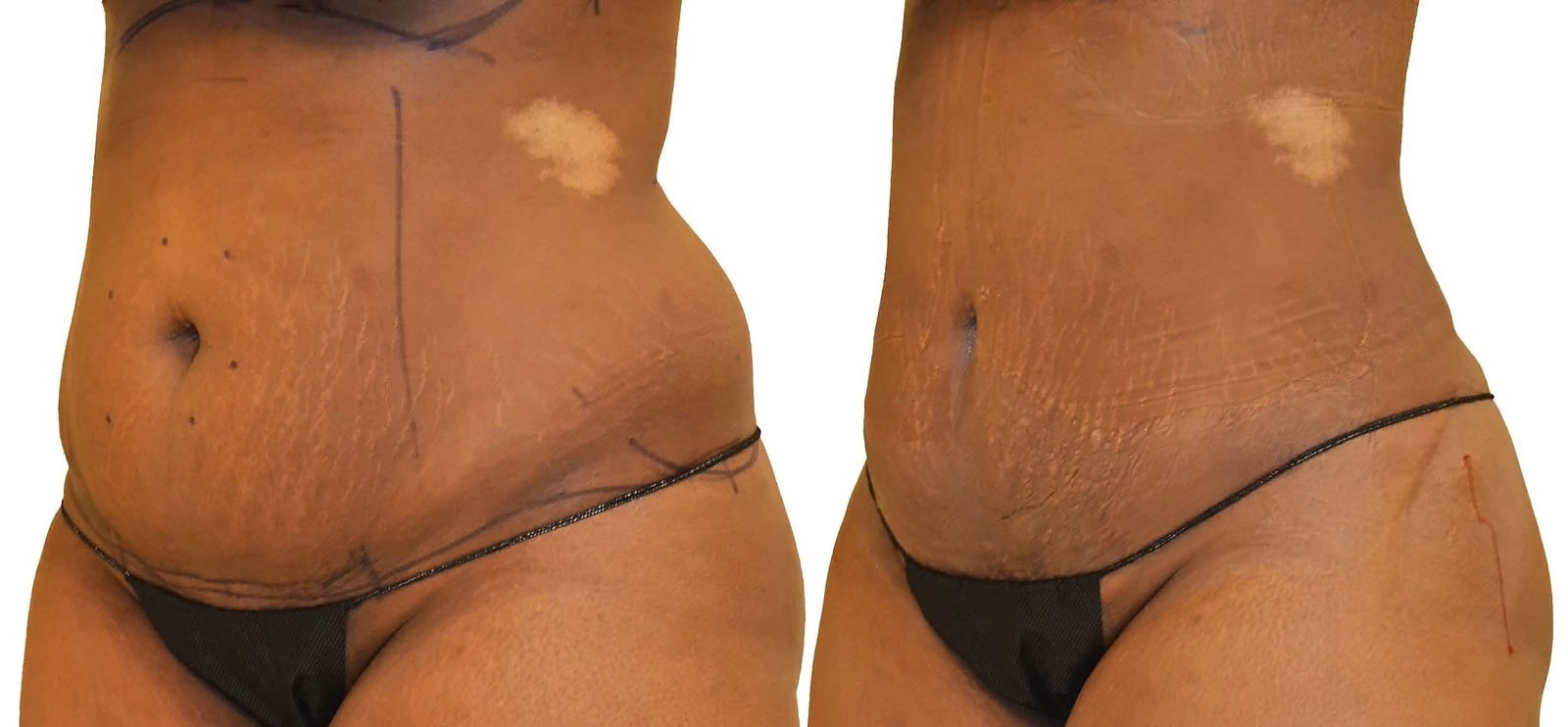 Lipo 360 before and after, actual patient of Dr. Long
