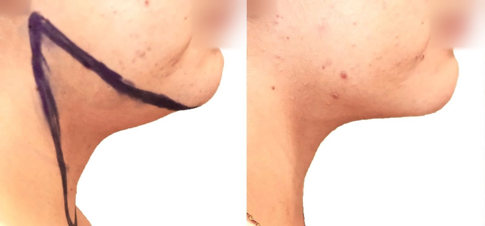 Chin and neck liposuction before and after, actual patient of Dr. Long