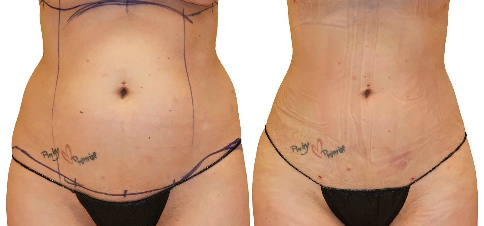 Lipo 360 before and after, actual patient of Dr. Long