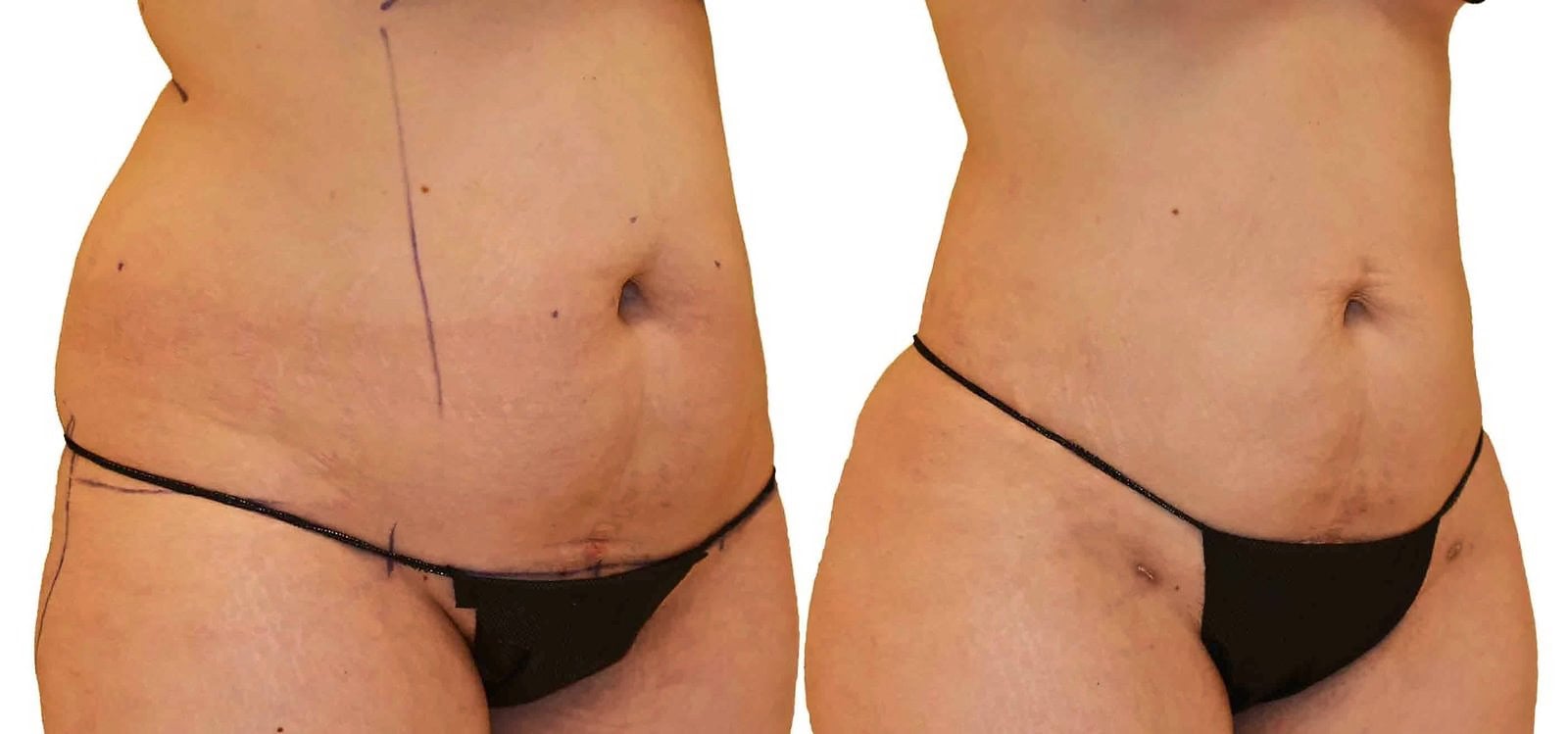 Lipo 360 before and after, actual patient of Dr. Long