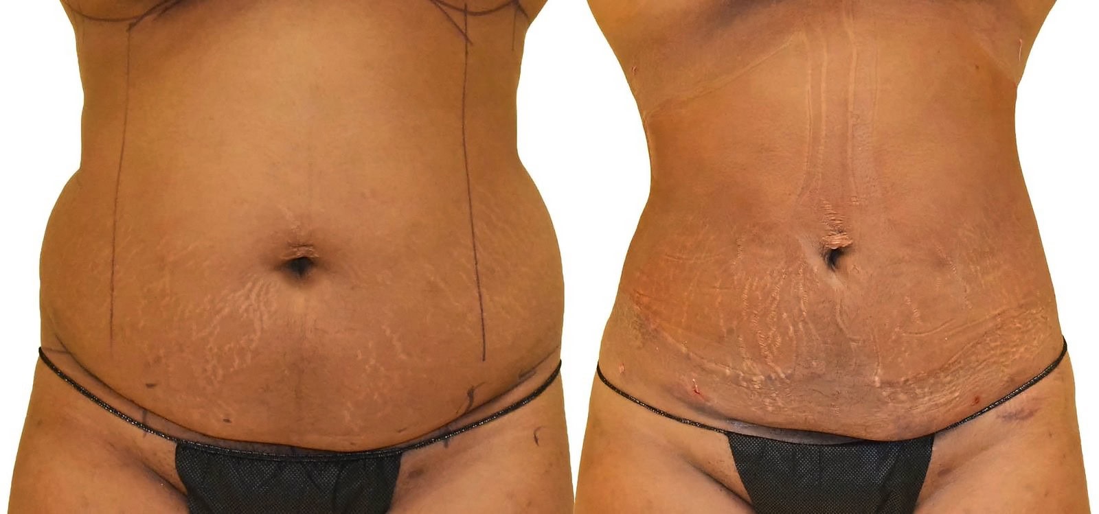 Lipo 360 before and after, actual patient of Dr. Long