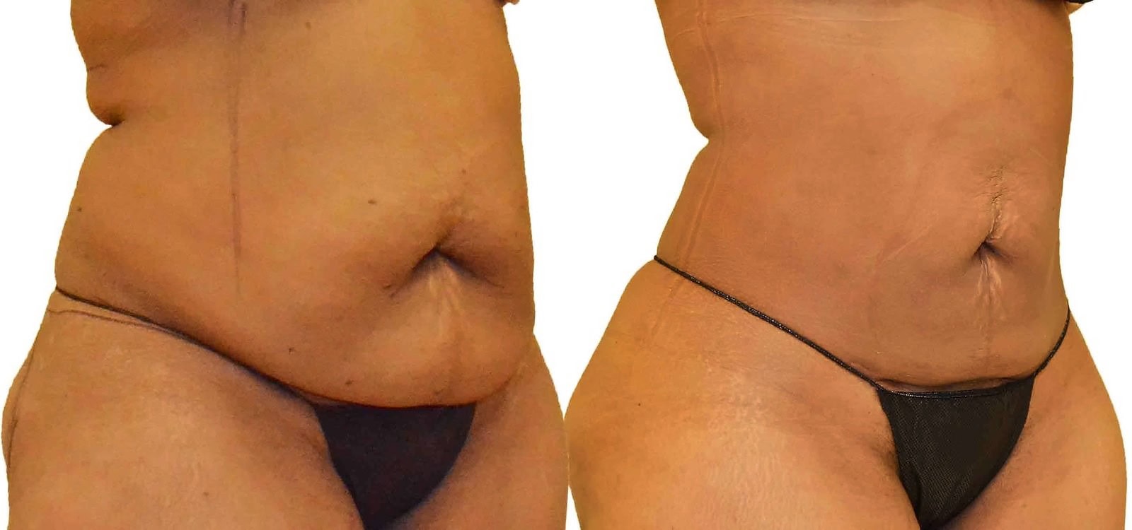 Lipo 360 before and after, actual patient of Dr. Long