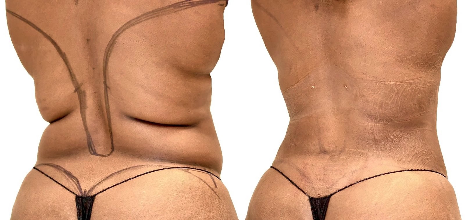 Lipo 360 before and after, actual patient of Dr. Long
