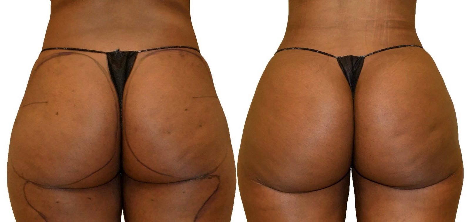 Thigh liposuction before and after, actual patient of Dr. Long