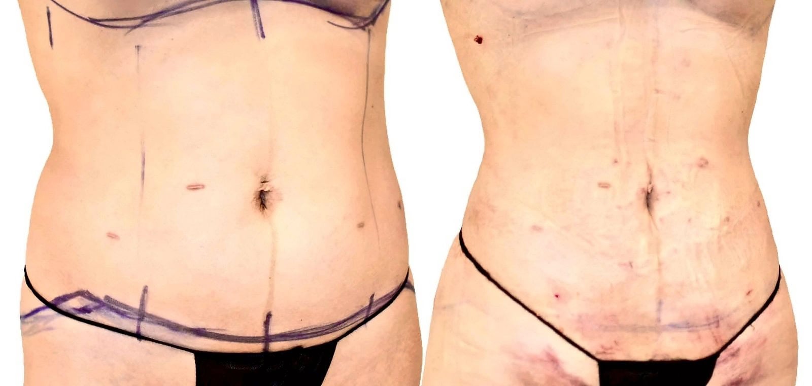 Lipo 360 before and after, actual patient of Dr. Long