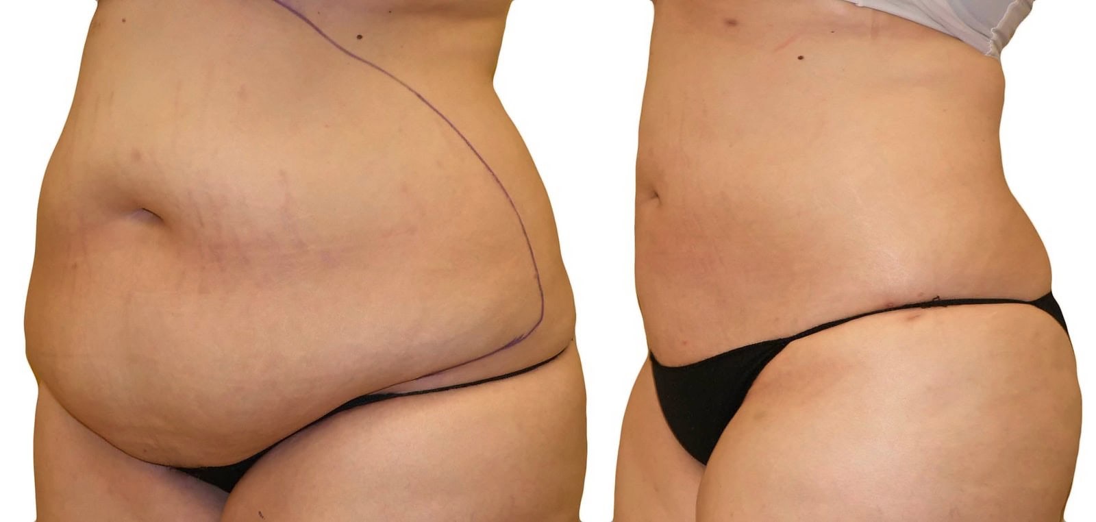 Lipo 360 before and after, actual patient of Dr. Long