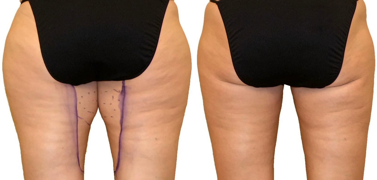 Thigh liposuction before and after, actual patient of Dr. Long