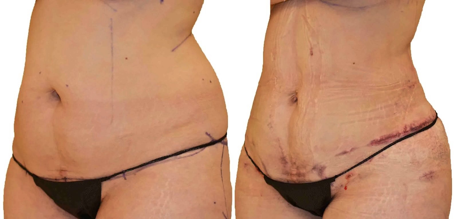 Lipo 360 before and after, actual patient of Dr. Long