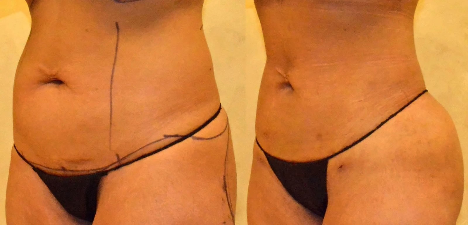 Lipo 360 before and after, actual patient of Dr. Long