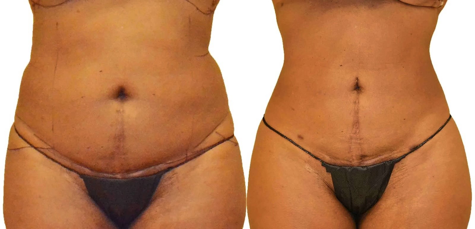 Lipo 360 before and after, actual patient of Dr. Long