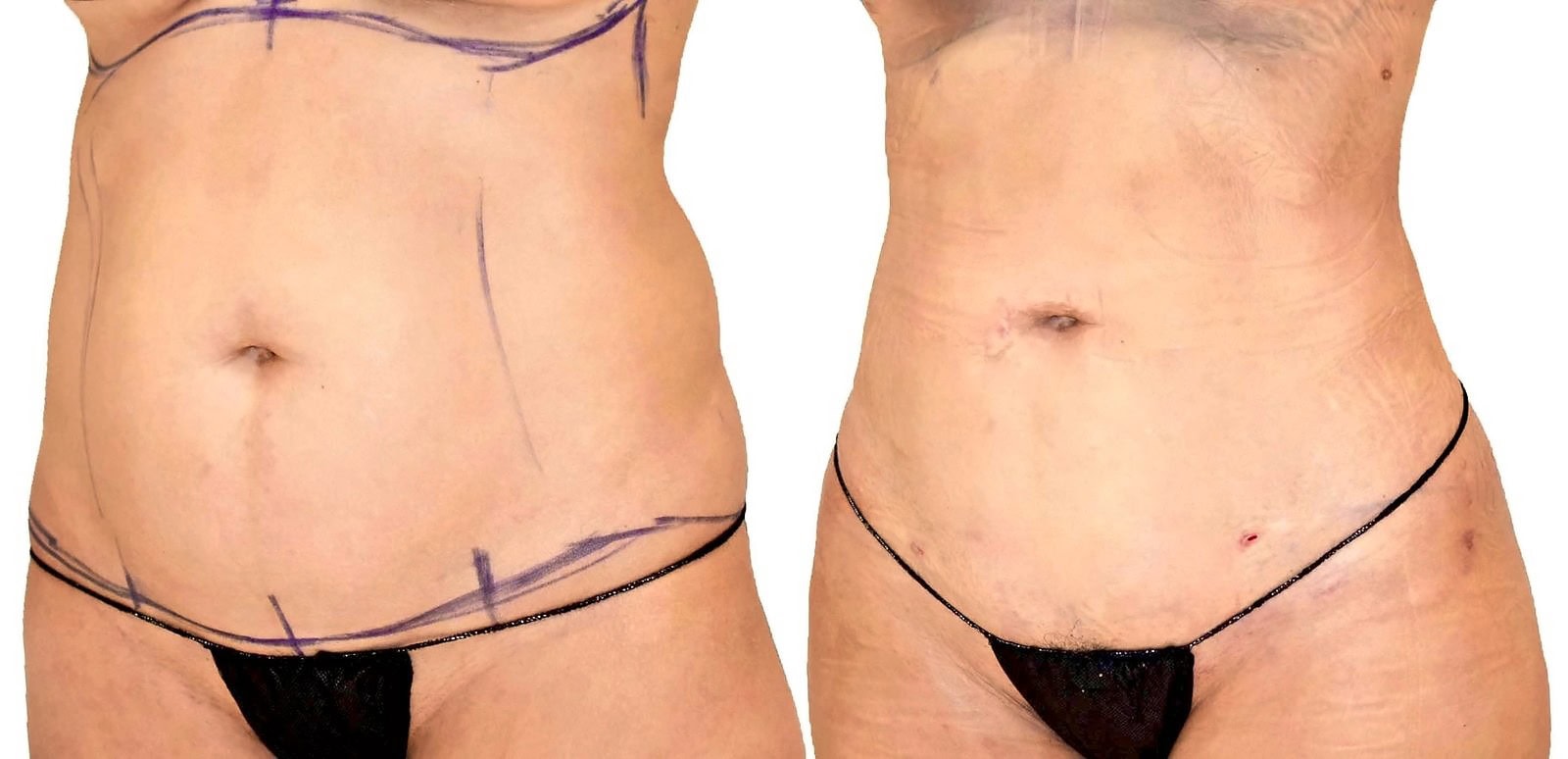 Lipo 360 before and after, actual patient of Dr. Long