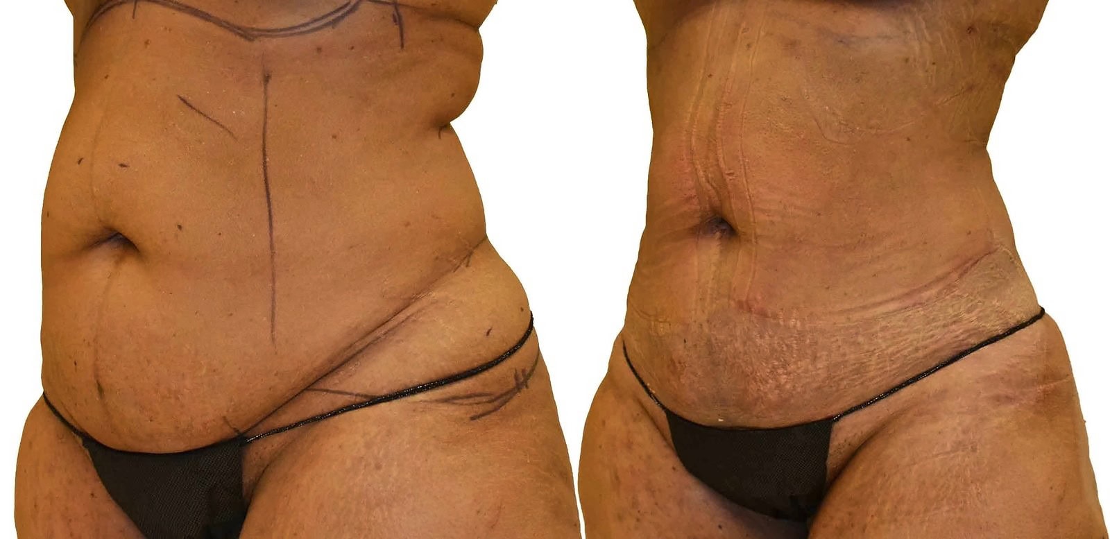 Lipo 360 before and after, actual patient of Dr. Long