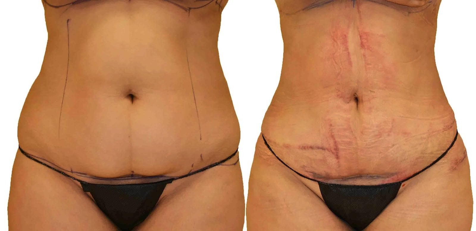 Lipo 360 before and after, actual patient of Dr. Long