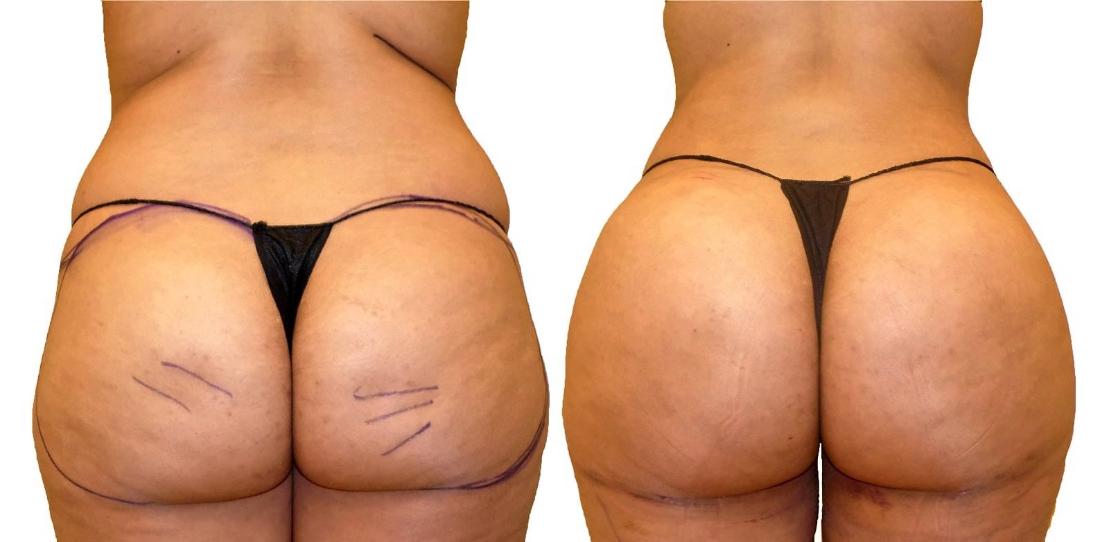 Fat Transfer, BBL before and after, actual patient of Dr. Long