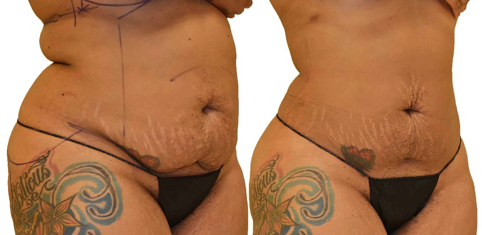 Lipo 360 before and after, actual patient of Dr. Long
