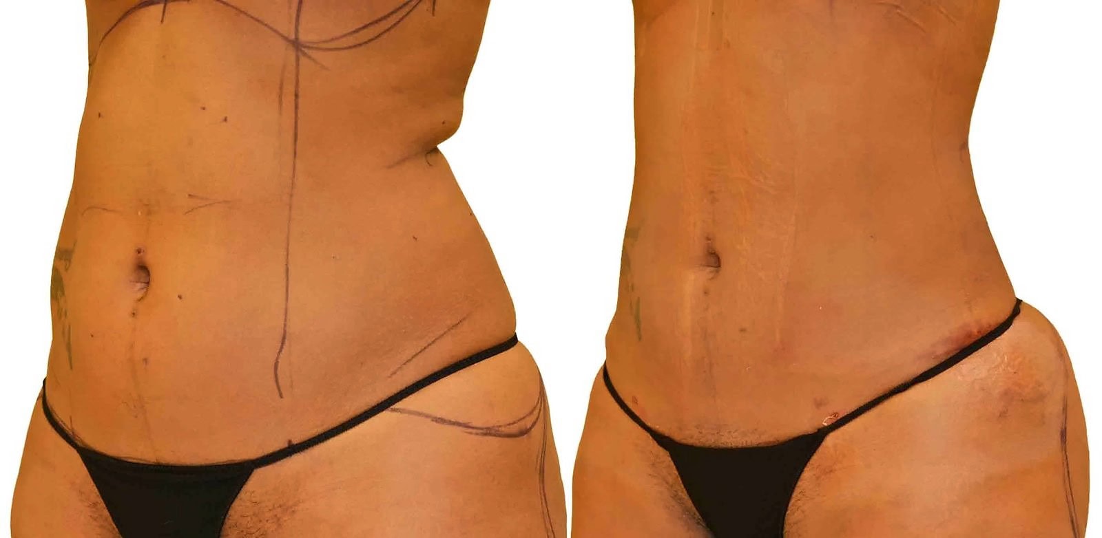 Lipo 360 before and after, actual patient of Dr. Long