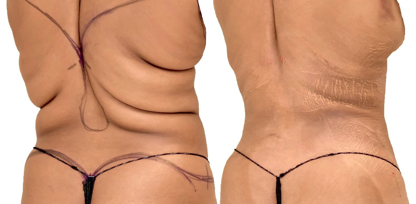 Lipo 360 before and after, actual patient of Dr. Long