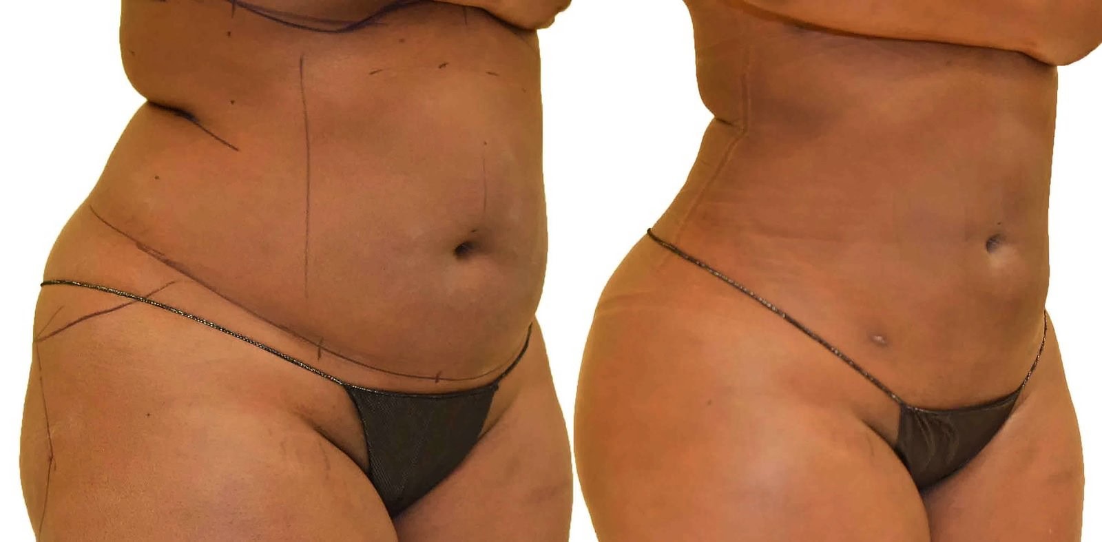 Lipo 360 before and after, actual patient of Dr. Long
