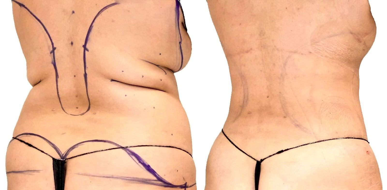 Lipo 360 before and after, actual patient of Dr. Long