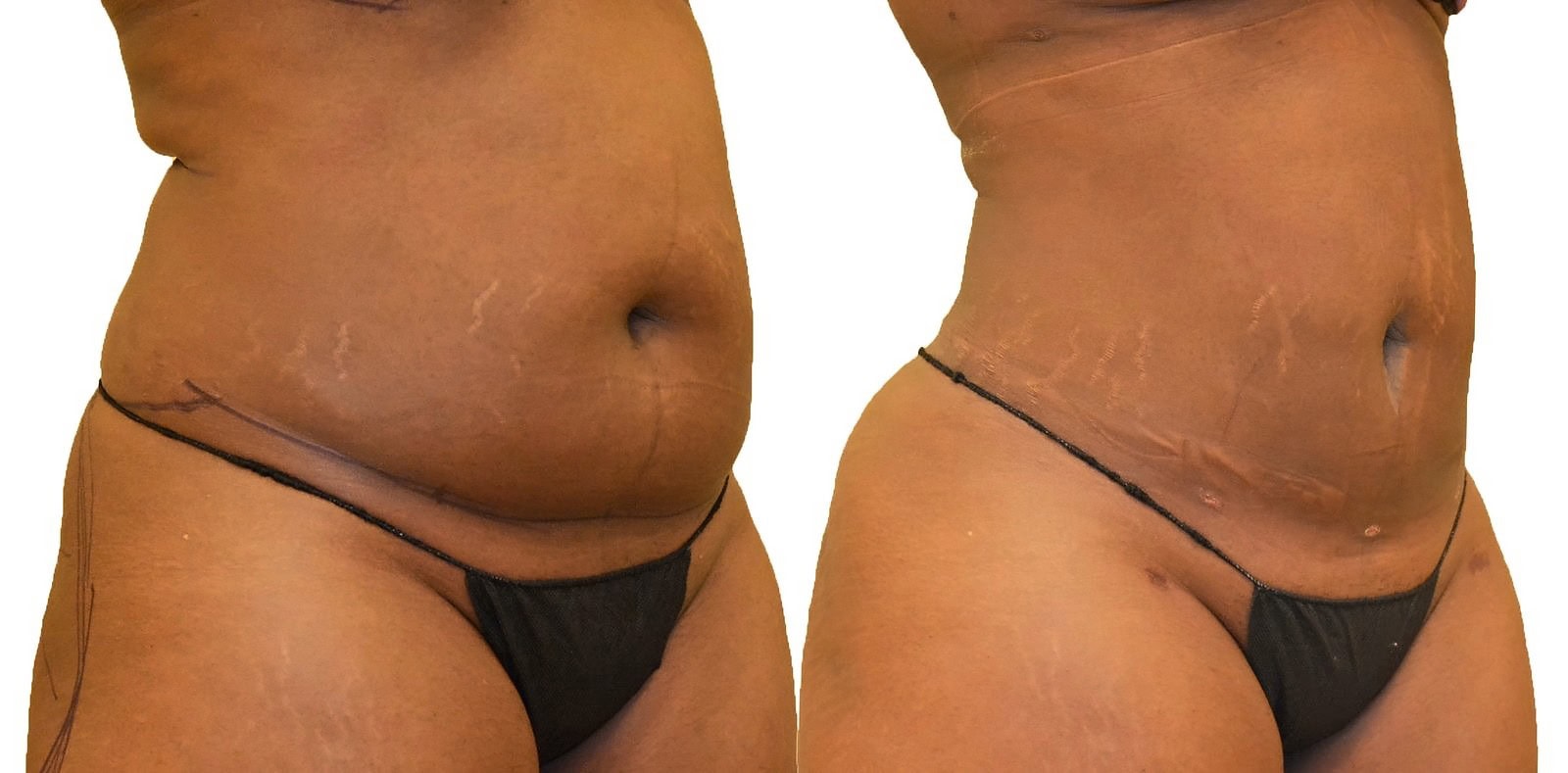 Lipo 360 before and after, actual patient of Dr. Long