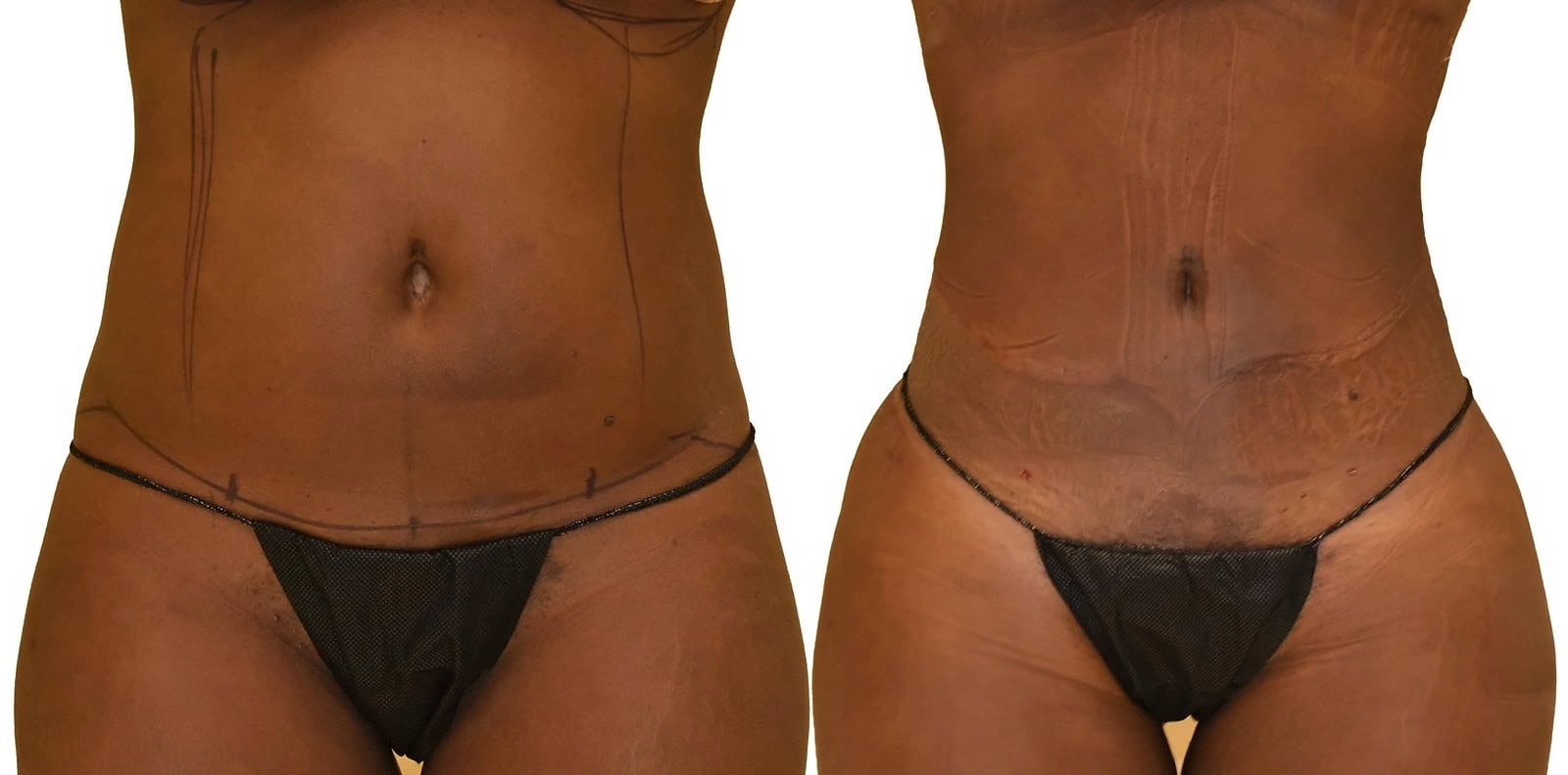 Lipo 360 before and after, actual patient of Dr. Long