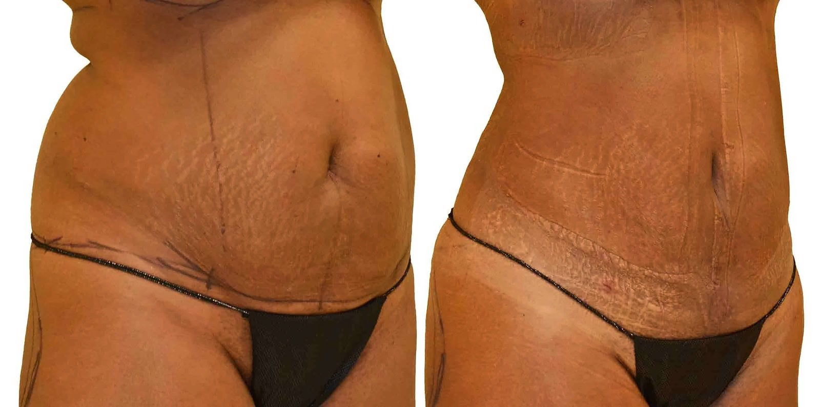 Lipo 360 before and after, actual patient of Dr. Long