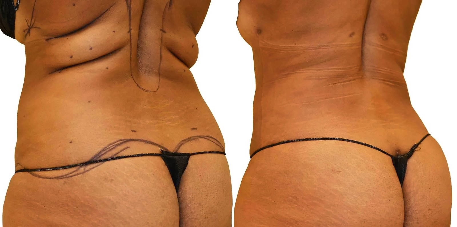 Fat Transfer, BBL before and after, actual patient of Dr. Long