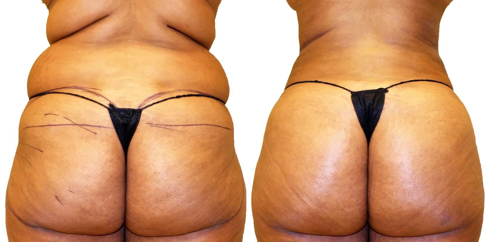 Fat Transfer, BBL before and after, actual patient of Dr. Long