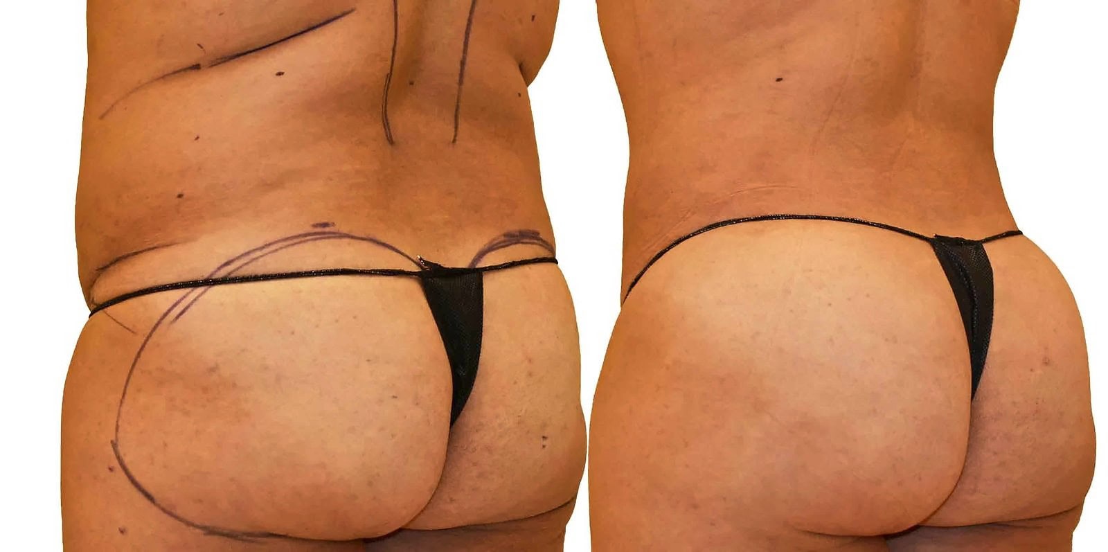 Fat Transfer, BBL before and after, actual patient of Dr. Long