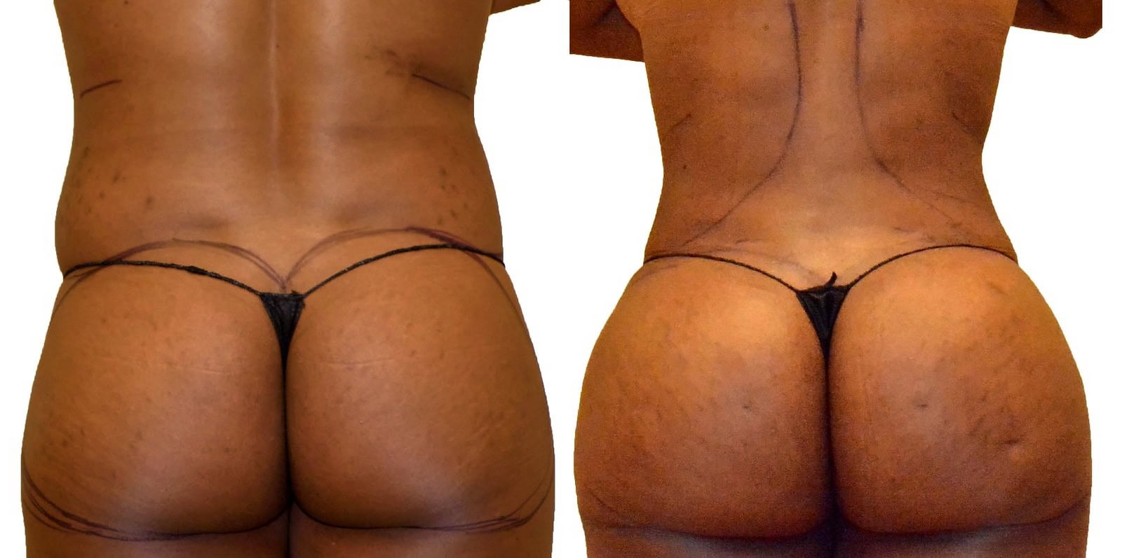 Fat Transfer, BBL before and after, actual patient of Dr. Long