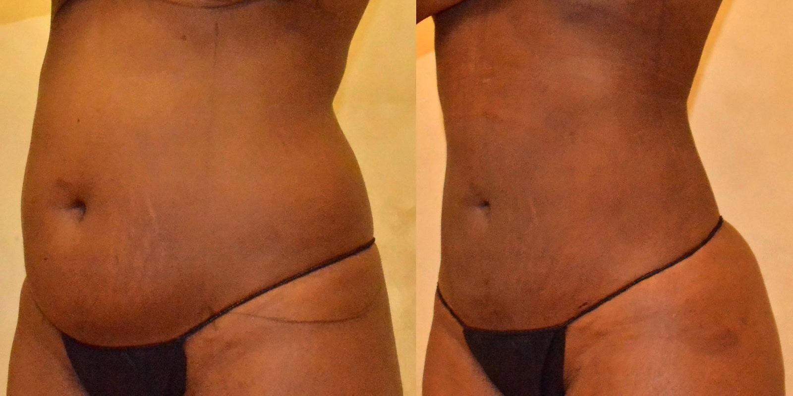 Lipo 360 before and after, actual patient of Dr. Long