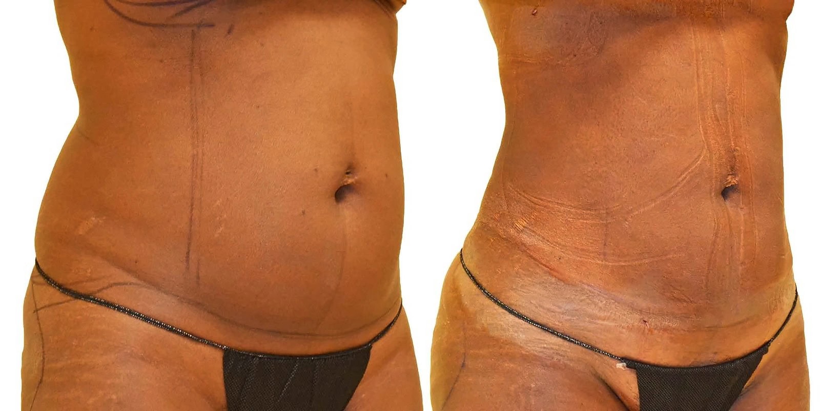 Lipo 360 before and after, actual patient of Dr. Long