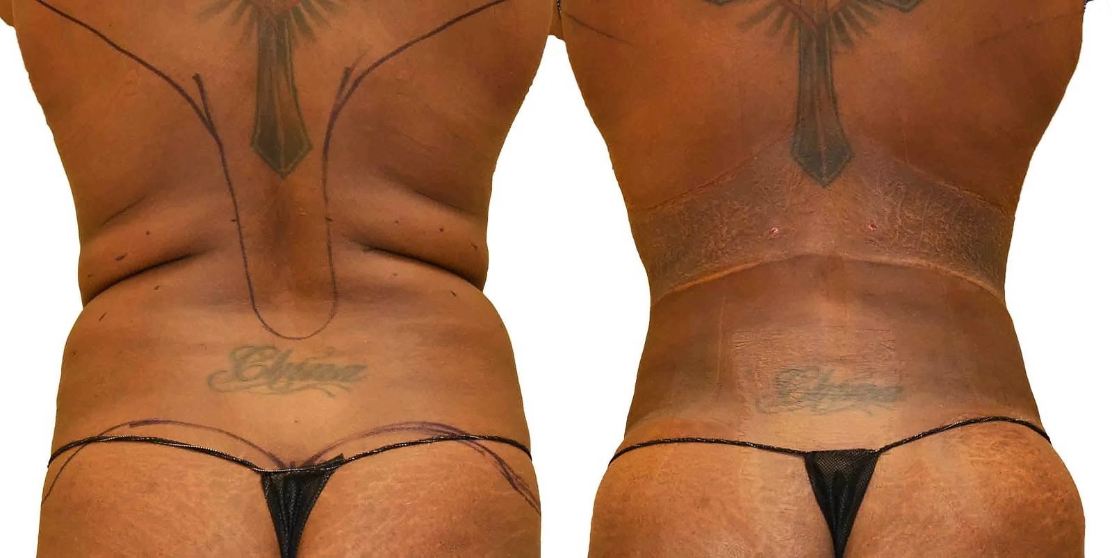 Fat Transfer, BBL before and after, actual patient of Dr. Long