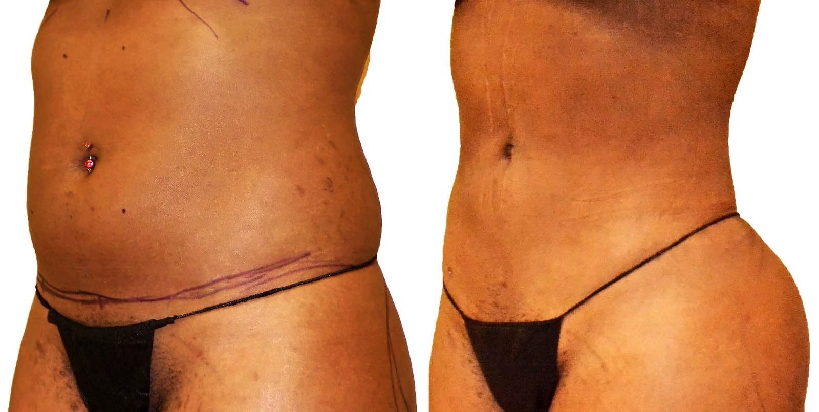 Lipo 360 before and after, actual patient of Dr. Long