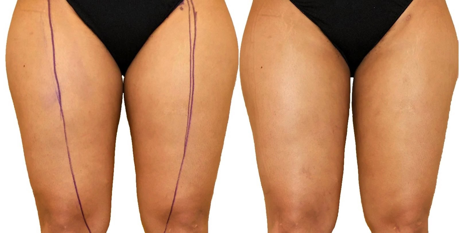 Thigh liposuction before and after, actual patient of Dr. Long