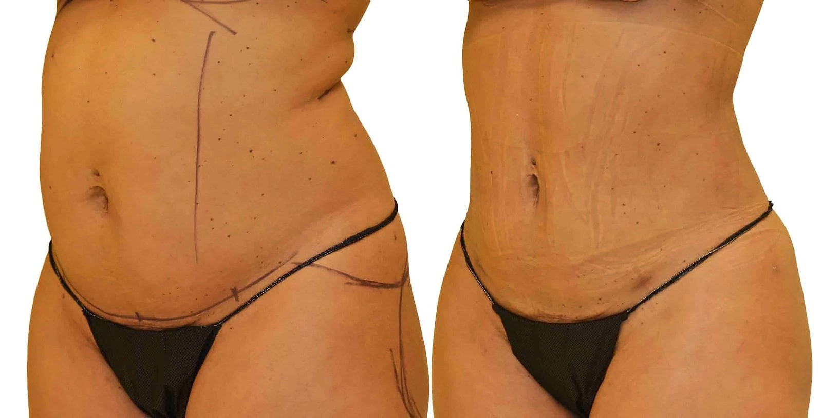 Lipo 360 before and after, actual patient of Dr. Long