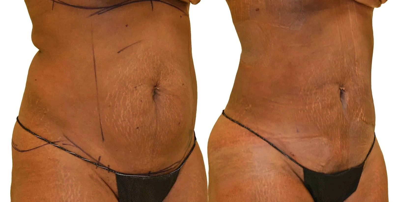 Lipo 360 before and after, actual patient of Dr. Long