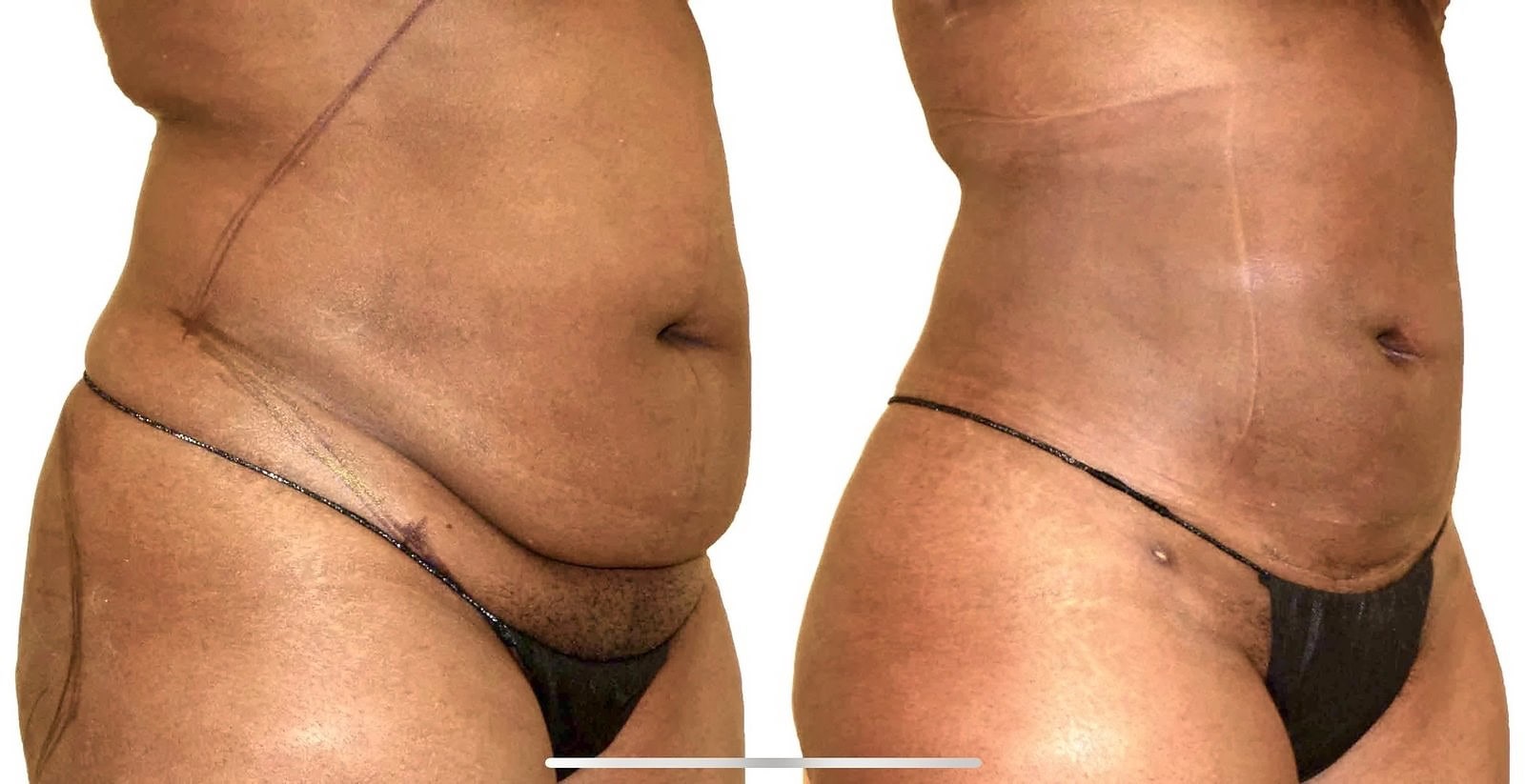 Lipo 360 before and after, actual patient of Dr. Long