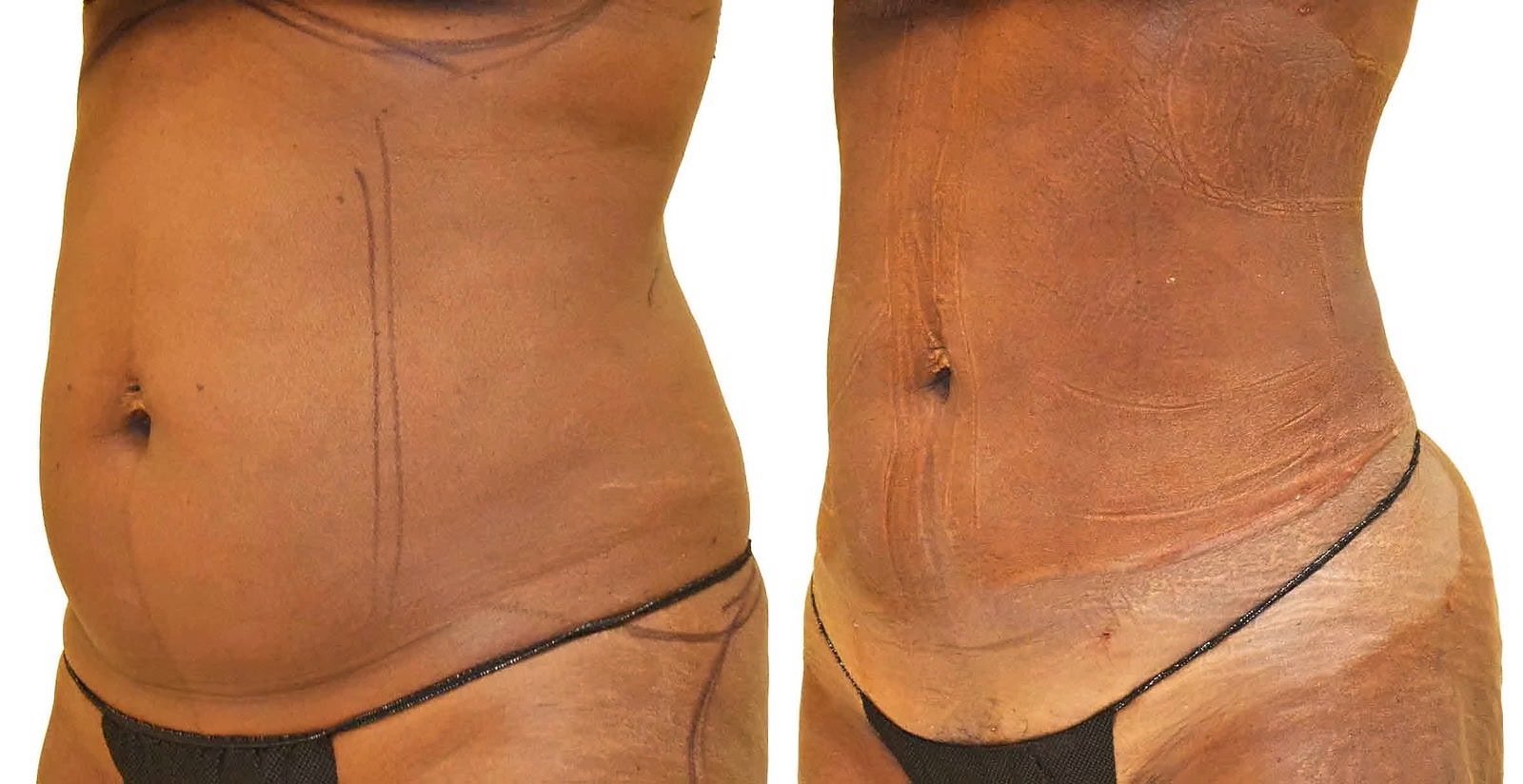 Lipo 360 before and after, actual patient of Dr. Long