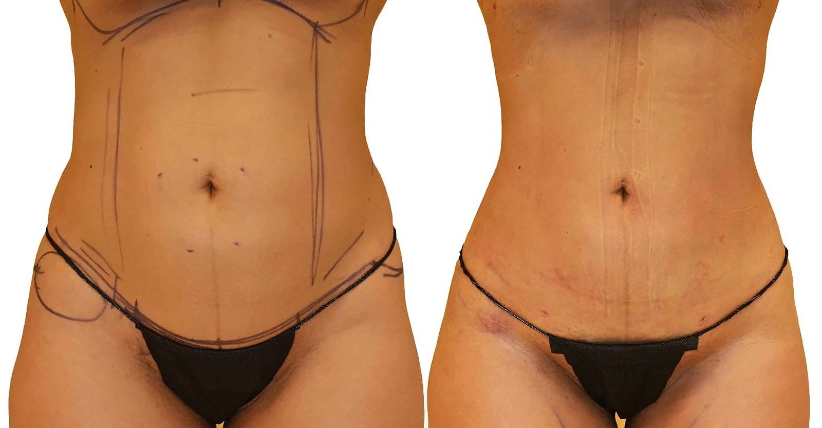 Lipo 360 before and after, actual patient of Dr. Long