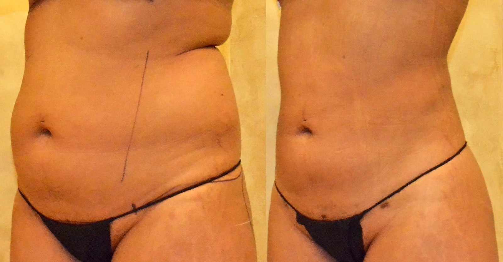 Lipo 360 before and after, actual patient of Dr. Long