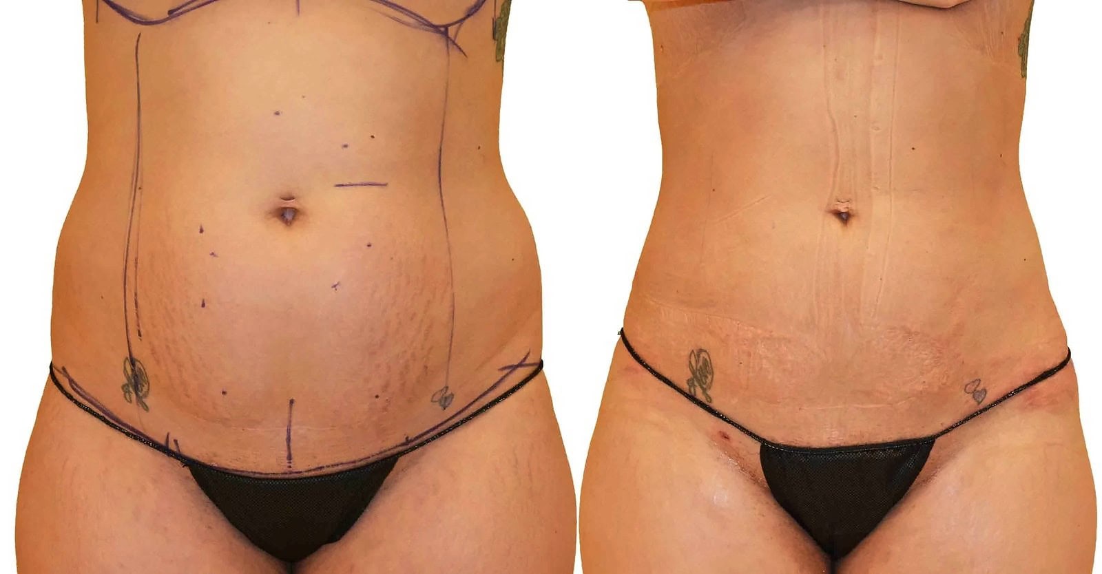 Lipo 360 before and after, actual patient of Dr. Long