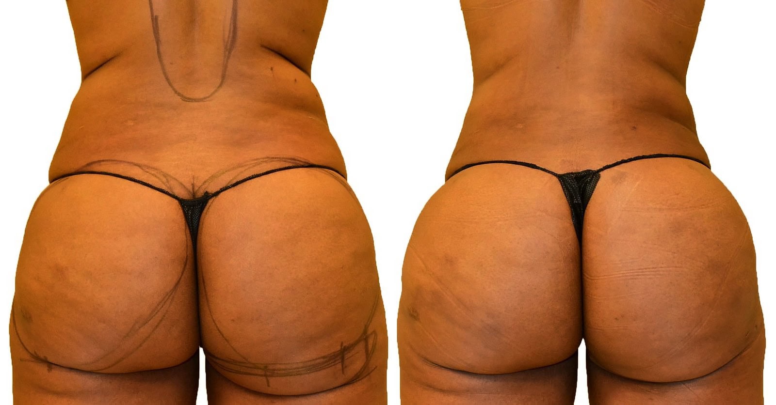 Fat Transfer, BBL before and after, actual patient of Dr. Long