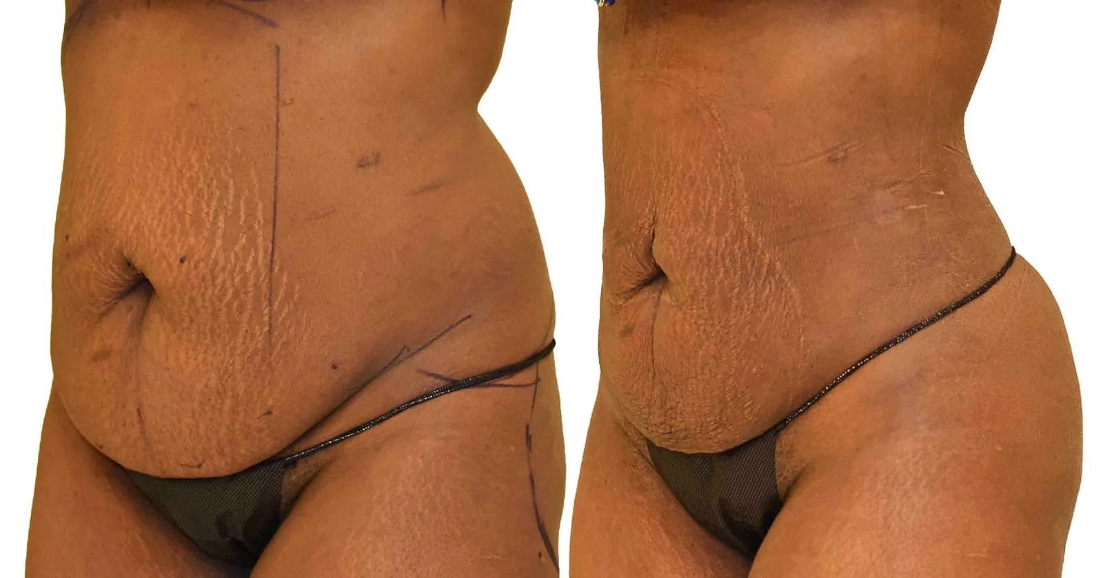 Lipo 360 before and after, actual patient of Dr. Long